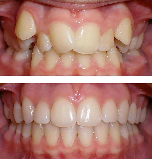 before teeth treatment extraction completed without patient months crowding