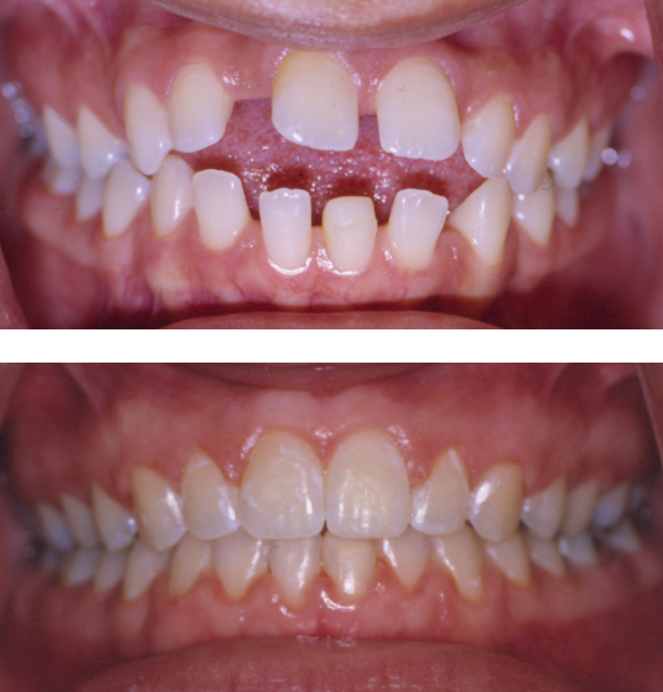 Before and After Associates in Orthodontics South